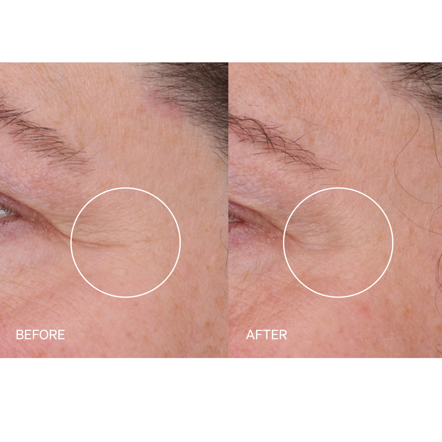 Before-and-after close-up comparison of an eye area showing skin texture and crow's feet, with white circles highlighting the treated region and text labels 'BEFORE' and 'AFTER'.