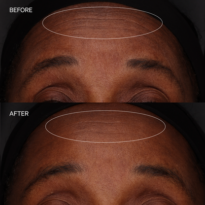 Before-and-after comparison of a person's forehead showing skin texture improvement, with the top labeled BEFORE and the bottom labeled AFTER.