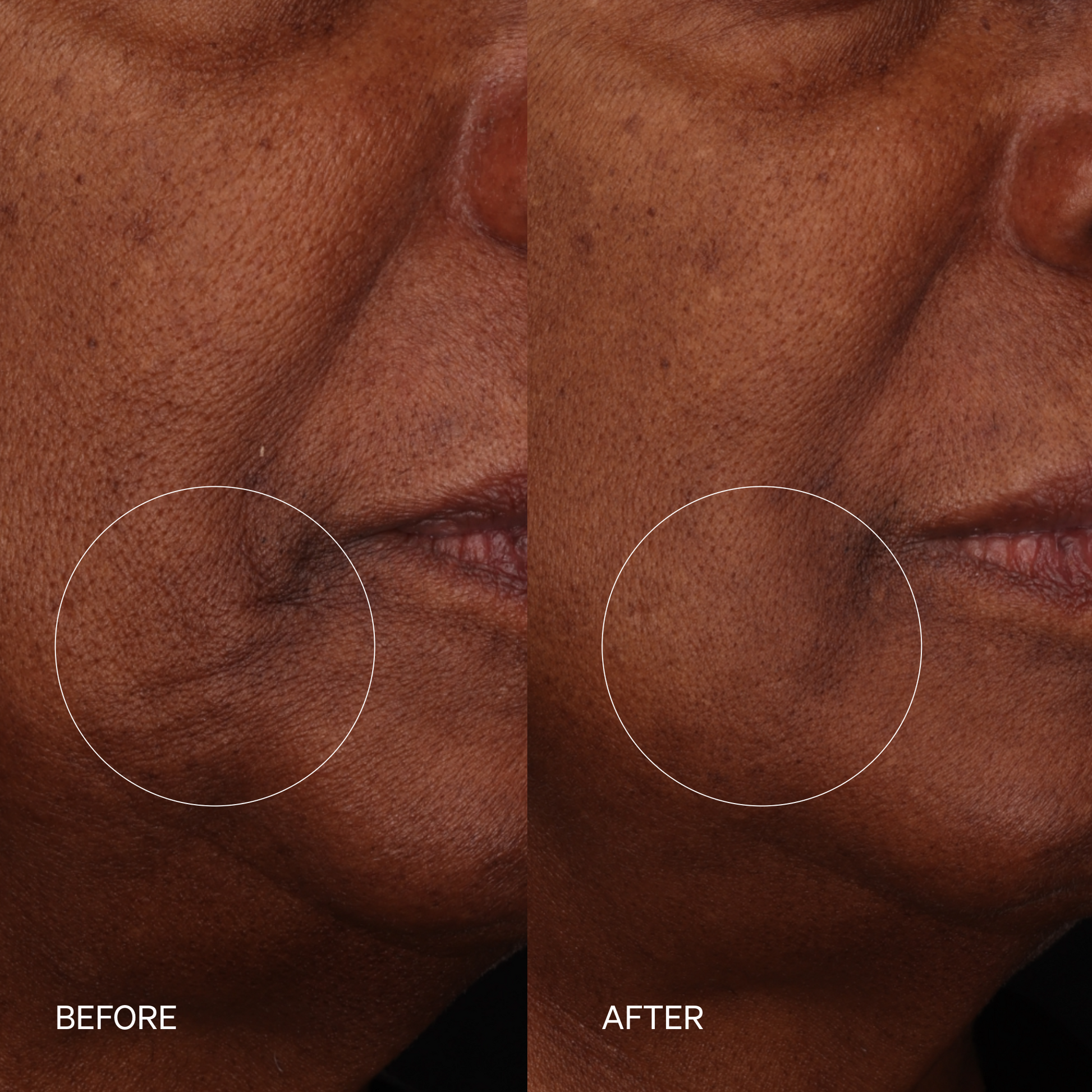 Before-and-after close-up of a person's lower face and jawline area, showing skin texture and wrinkle improvement. The left side is labeled BEFORE and shows more visible wrinkles around the mouth and jaw; the right side is labeled AFTER and appears smoother.
